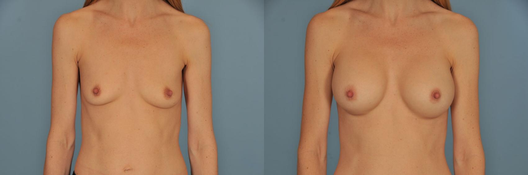 Before & After Breast Augmentation Case 15 View #1 View in Toronto, ON