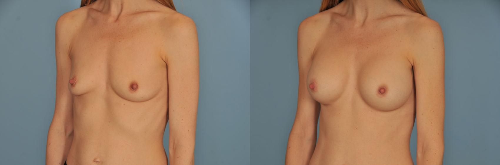 Before & After Breast Augmentation Case 15 View #2 View in Toronto, ON