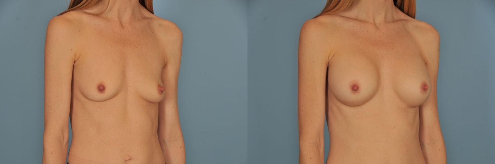 Before & After Breast Augmentation Case 15 View #3 View in Toronto, ON