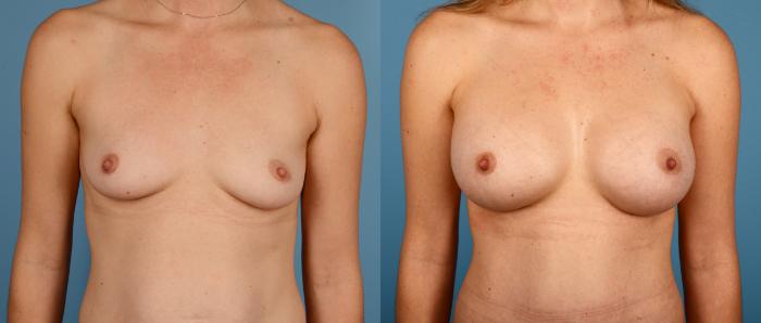 Before & After Breast Augmentation Case 173 View #1 View in Toronto, ON