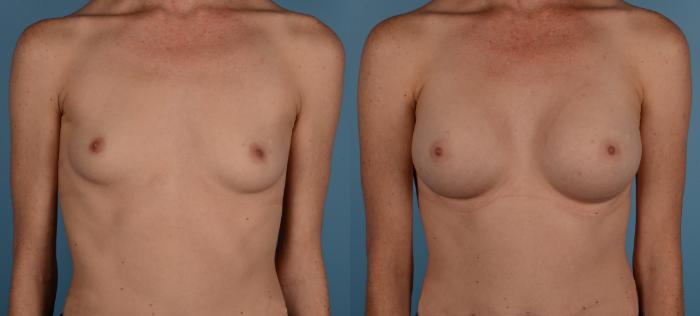 Before & After Breast Augmentation Case 179 View #1 View in Toronto, ON