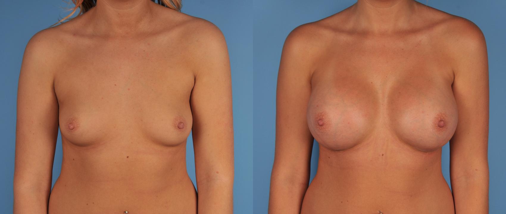 Before & After Breast Augmentation Case 19 View #1 View in Toronto, ON
