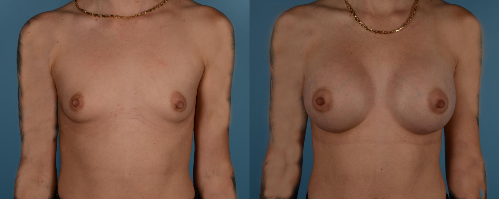 Before & After Breast Augmentation Case 215 View #1 View in Toronto, ON