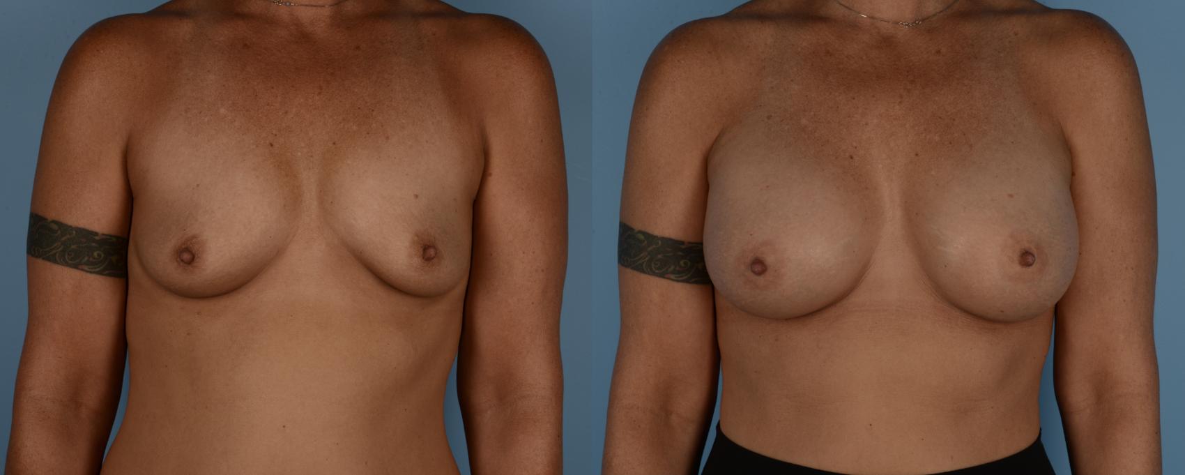 Before & After Breast Augmentation Case 234 View #1 View in Toronto, ON