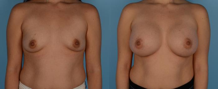 Before & After Breast Augmentation Case 240 View #1 View in Toronto, ON
