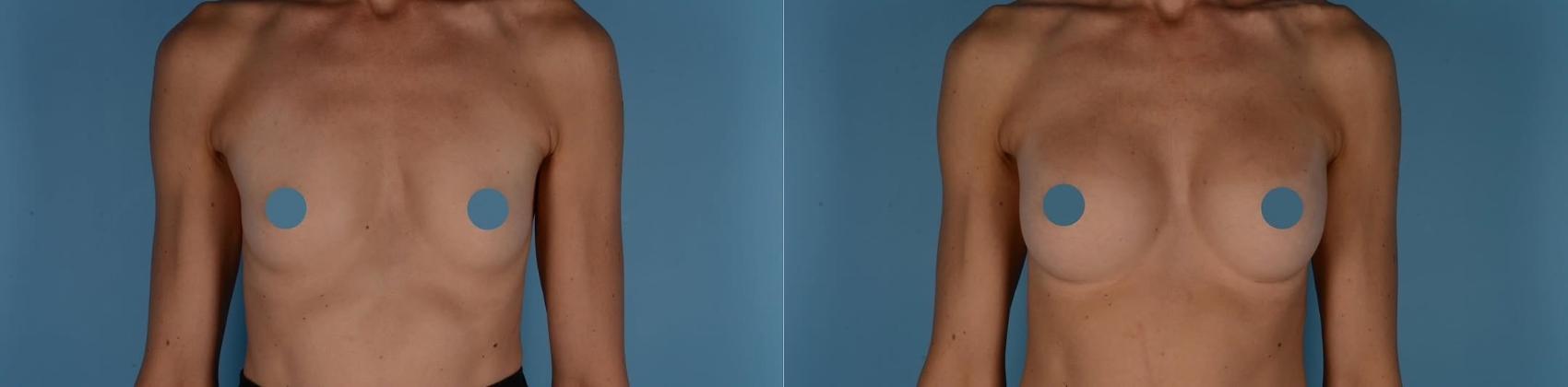 Before & After Breast Augmentation Case 327 Front View in Toronto, ON