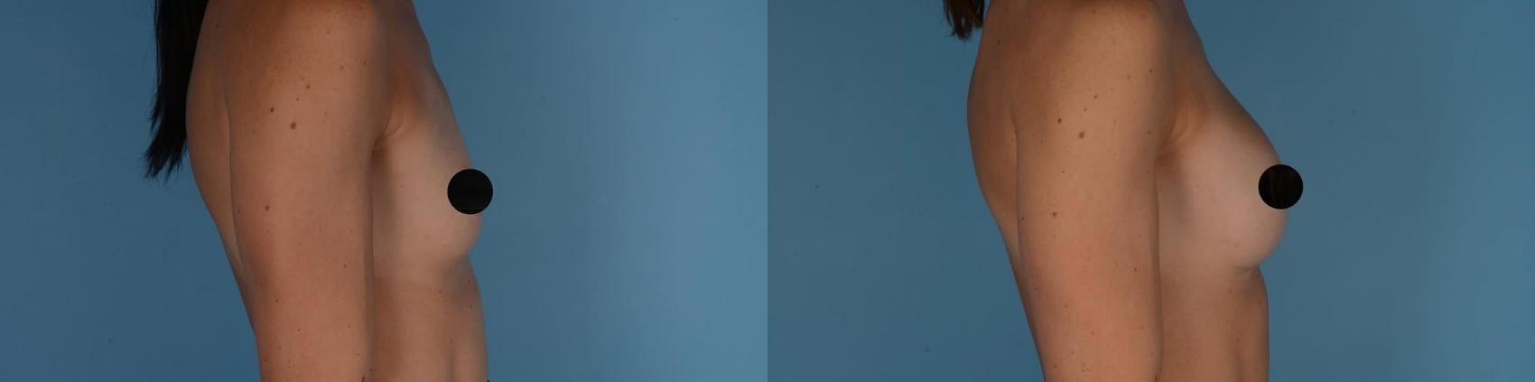 Before & After Breast Augmentation Case 327 Right Side View in Toronto, ON