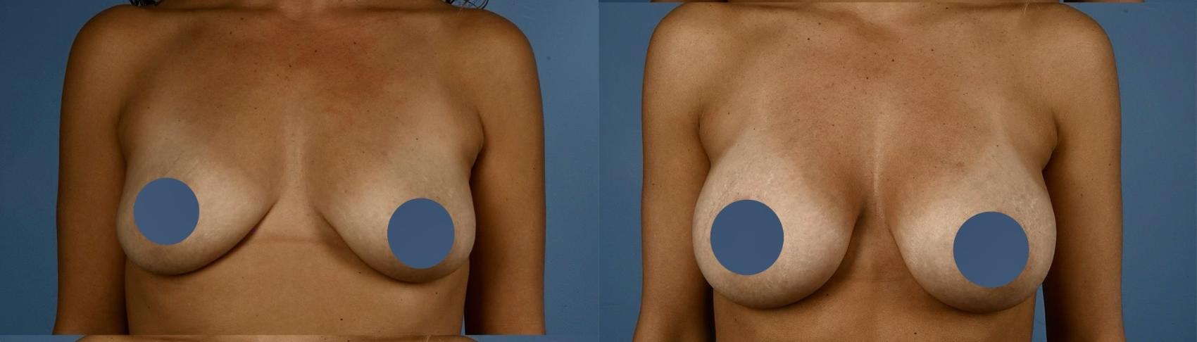 Before & After Breast Augmentation Case 343 Front View in Toronto, ON