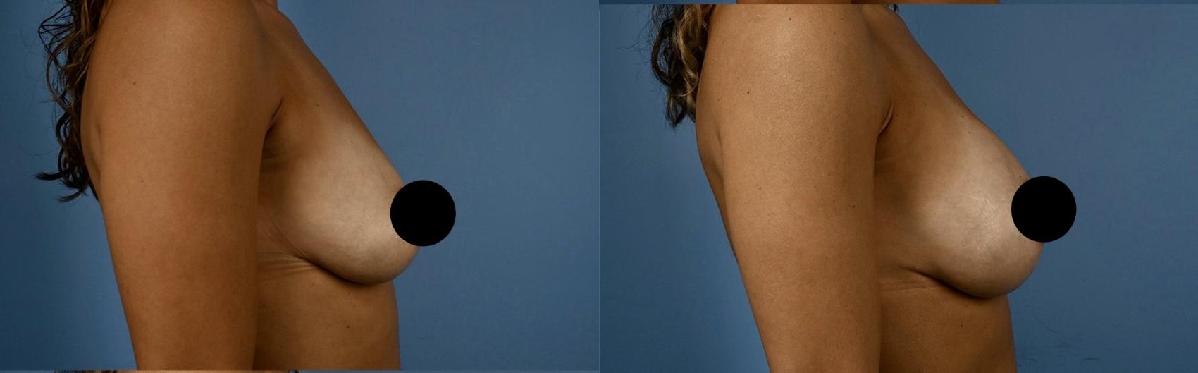 Before & After Breast Augmentation Case 343 Right Side View in Toronto, ON