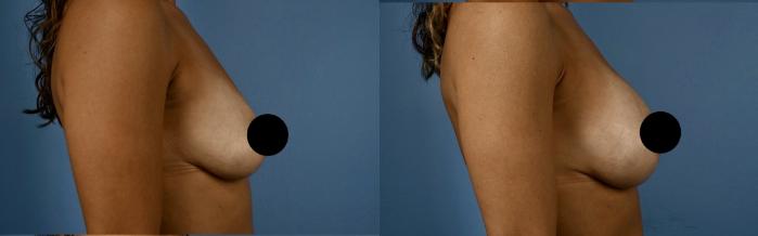 Before & After Breast Augmentation Case 343 Right Side View in Toronto, ON