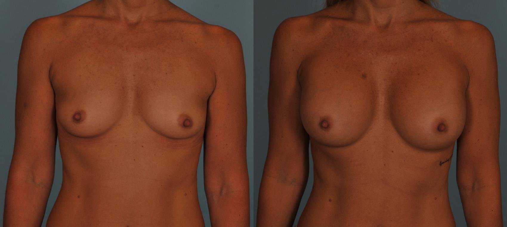 Before & After Breast Augmentation Case 45 View #1 View in Toronto, ON