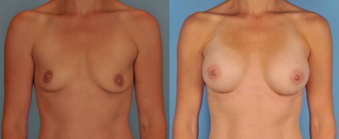 Before & After Breast Augmentation Case 55 View #1 View in Toronto, ON