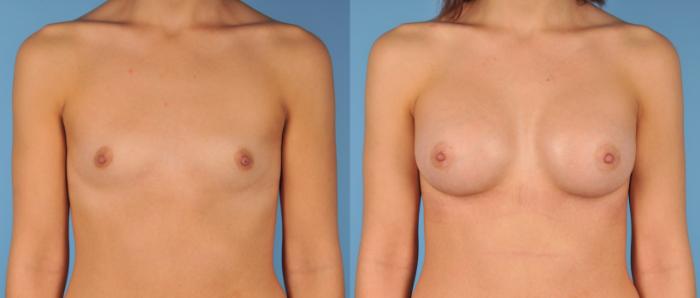 Before & After Breast Augmentation Case 56 View #1 View in Toronto, ON