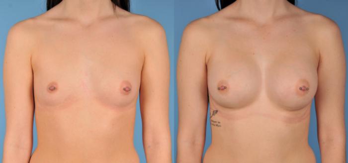Before & After Breast Augmentation Case 57 View #1 View in Toronto, ON