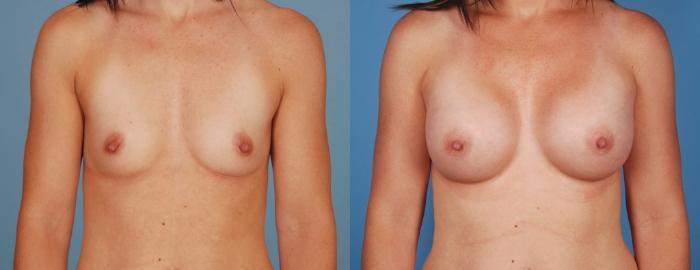 Before & After Breast Augmentation Case 64 View #1 View in Toronto, ON
