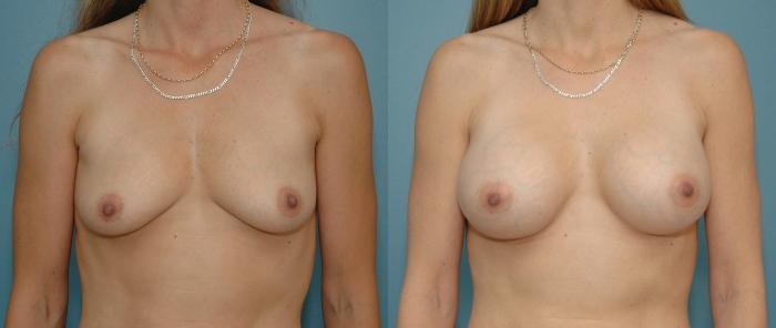 Before & After Breast Augmentation Case 65 View #1 View in Toronto, ON