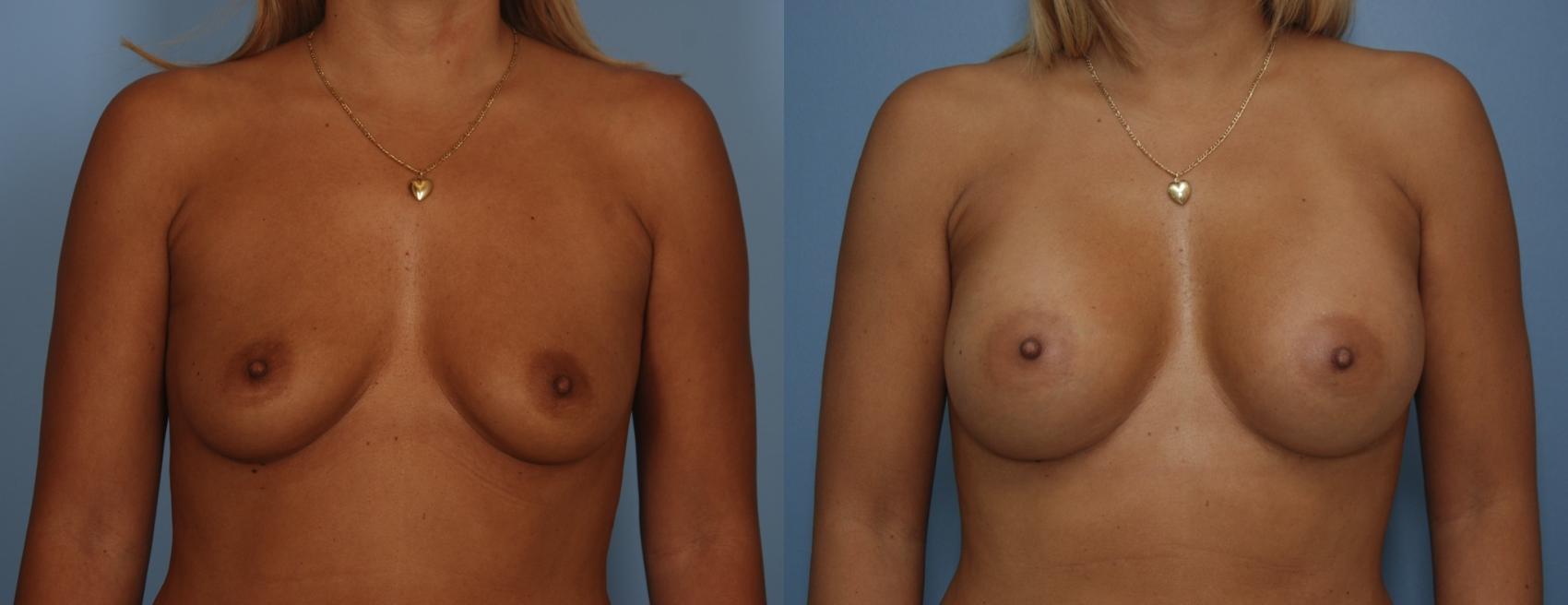 Before & After Breast Augmentation Case 77 View #1 View in Toronto, ON