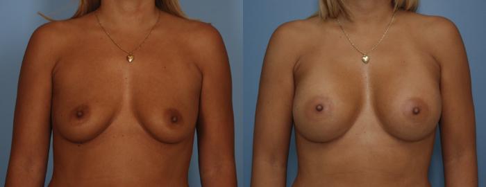 Before & After Breast Augmentation Case 77 View #1 View in Toronto, ON