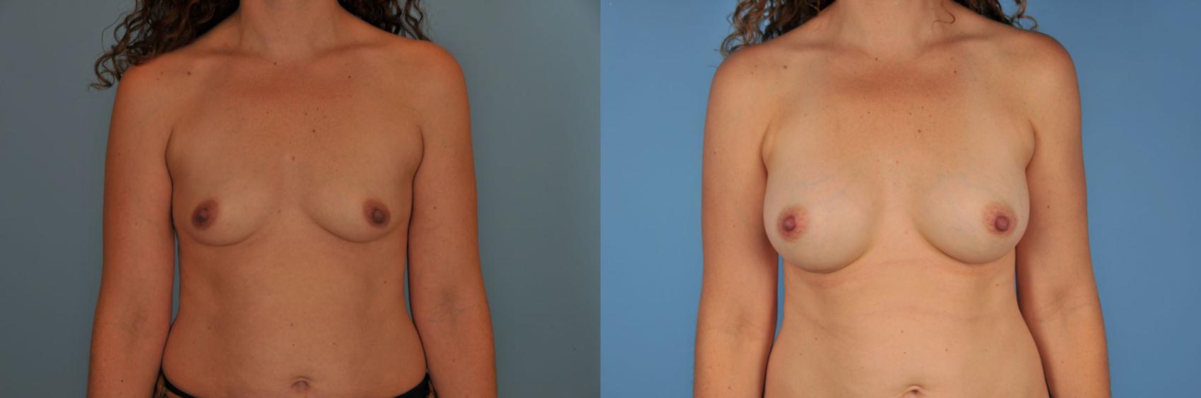 Before & After Breast Augmentation Case 8 View #1 View in Toronto, ON