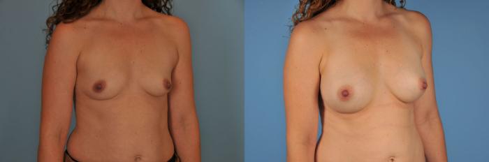Before & After Breast Augmentation Case 8 View #4 View in Toronto, ON