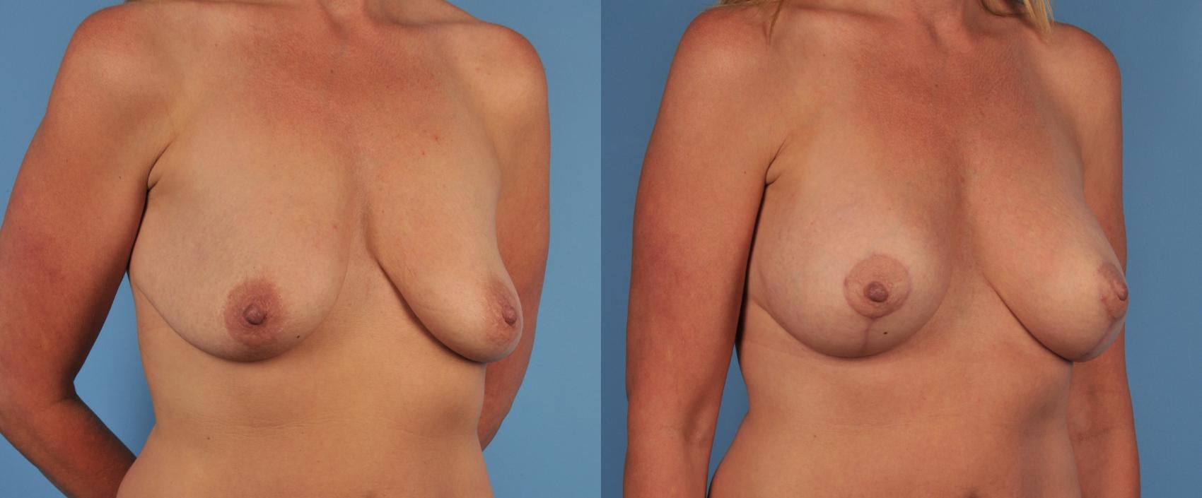 Before & After Breast Lift Case 150 View #1 View in Toronto, ON