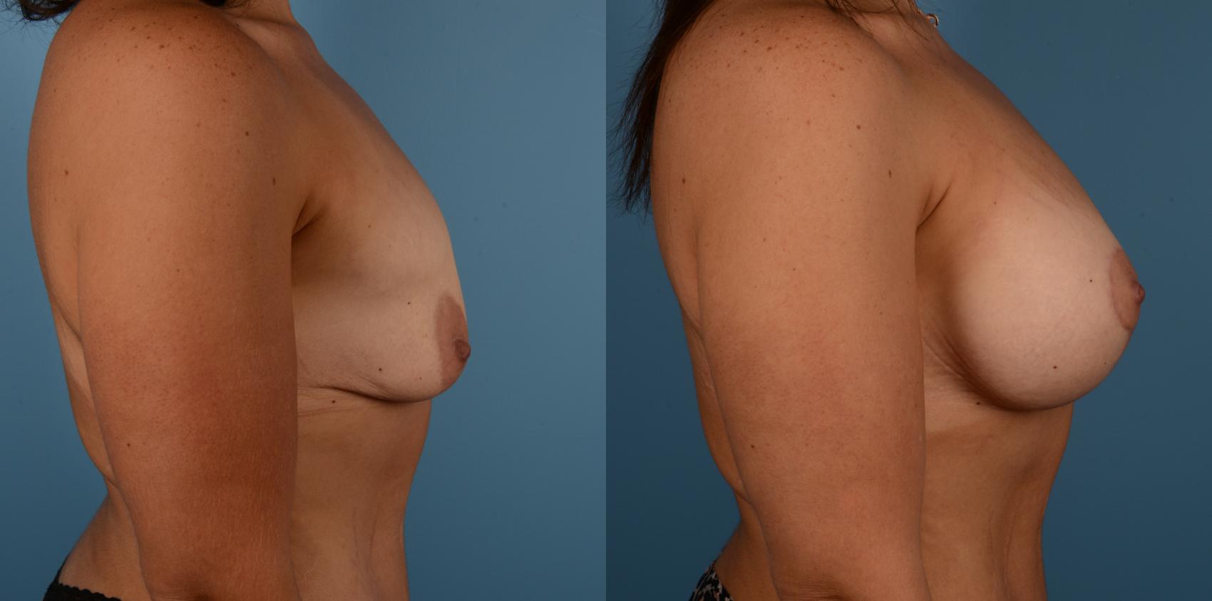 Before & After Breast Lift Case 178 View #1 View in Toronto, ON