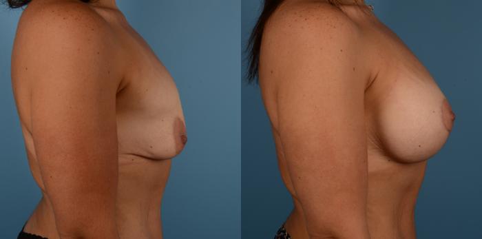 Before & After Breast Lift Case 178 View #1 View in Toronto, ON