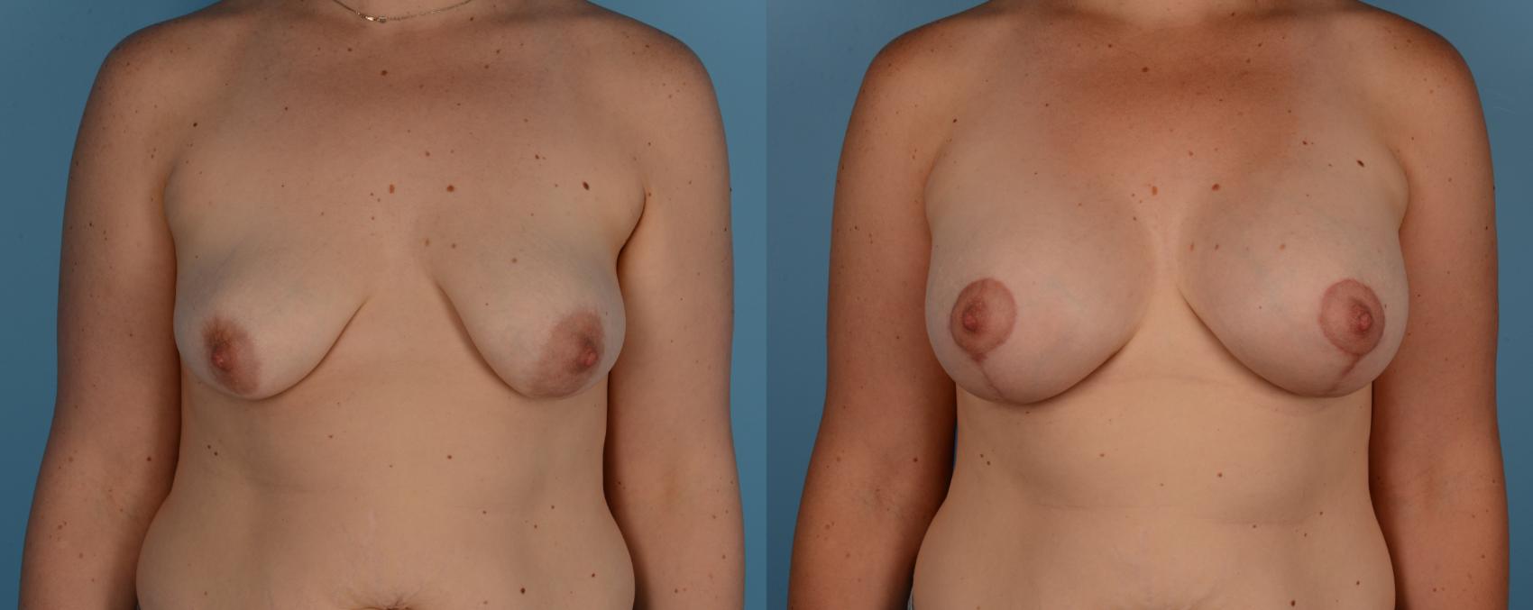 Before & After Breast Lift Case 183 View #1 View in Toronto, ON