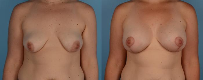 Before & After Breast Lift Case 183 View #1 View in Toronto, ON