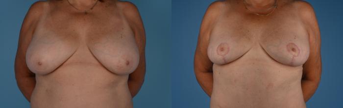 Breast Lift Before and After Photo Steven A. Hanna MD, Toronto, Canada