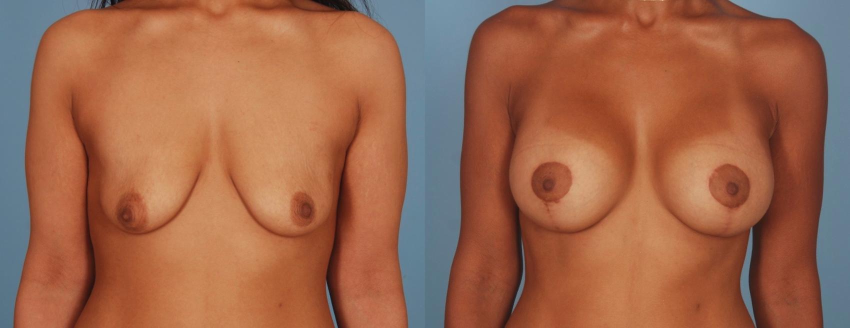 Before & After Breast Lift Case 34 View #1 View in Toronto, ON
