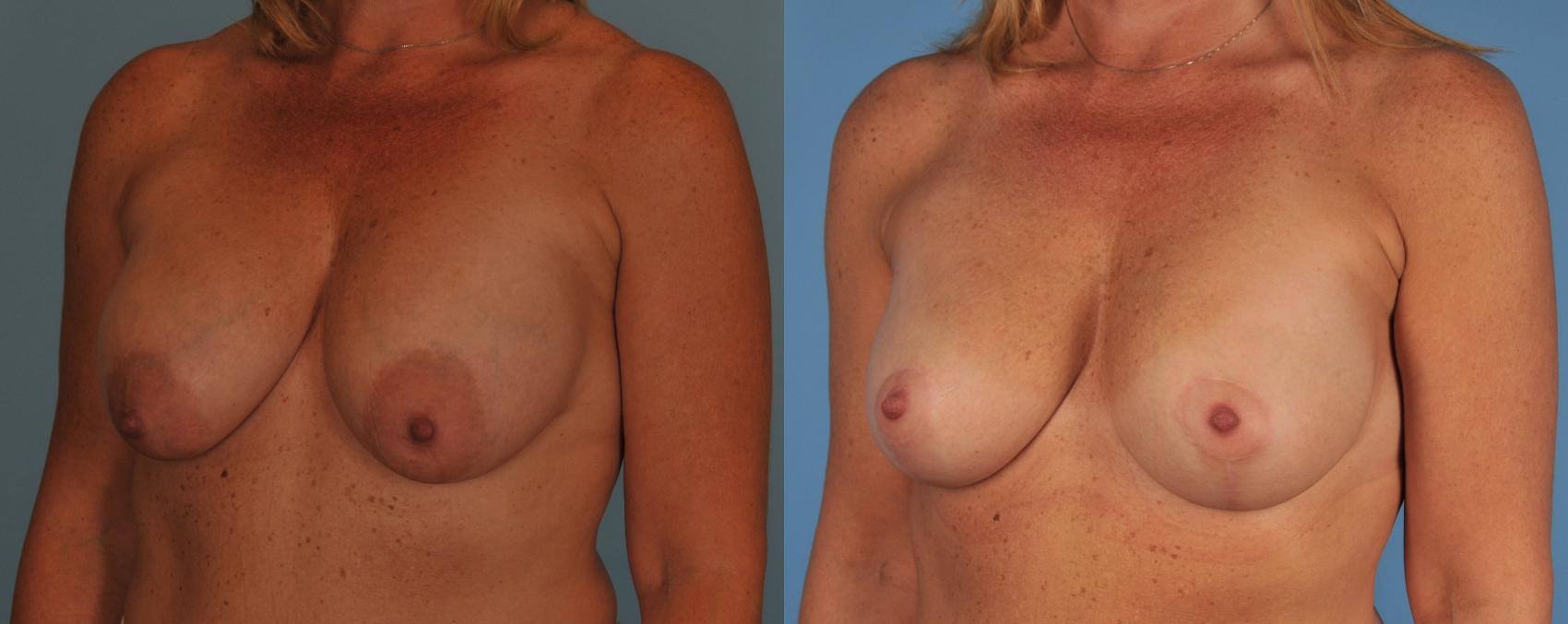 Before & After Breast Lift Case 59 View #1 View in Toronto, ON