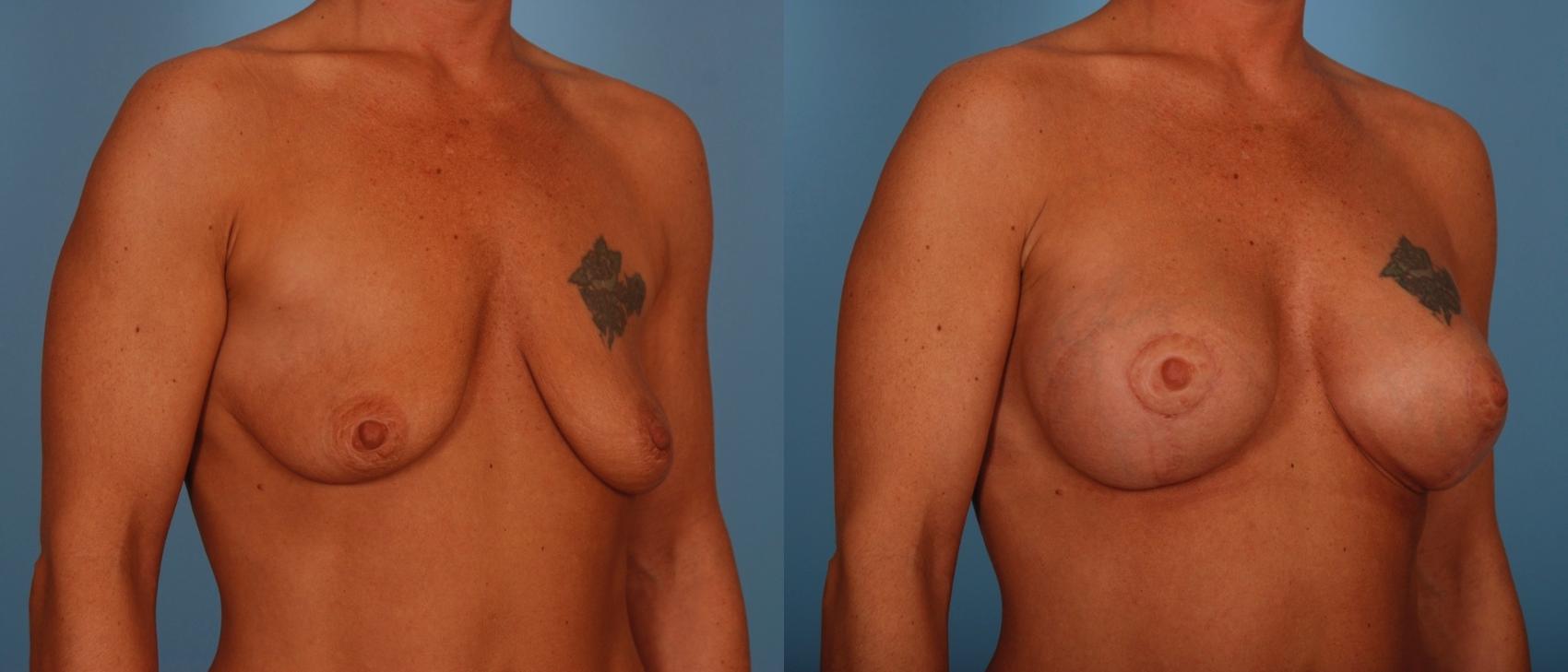 Before & After Breast Lift Case 60 View #1 View in Toronto, ON