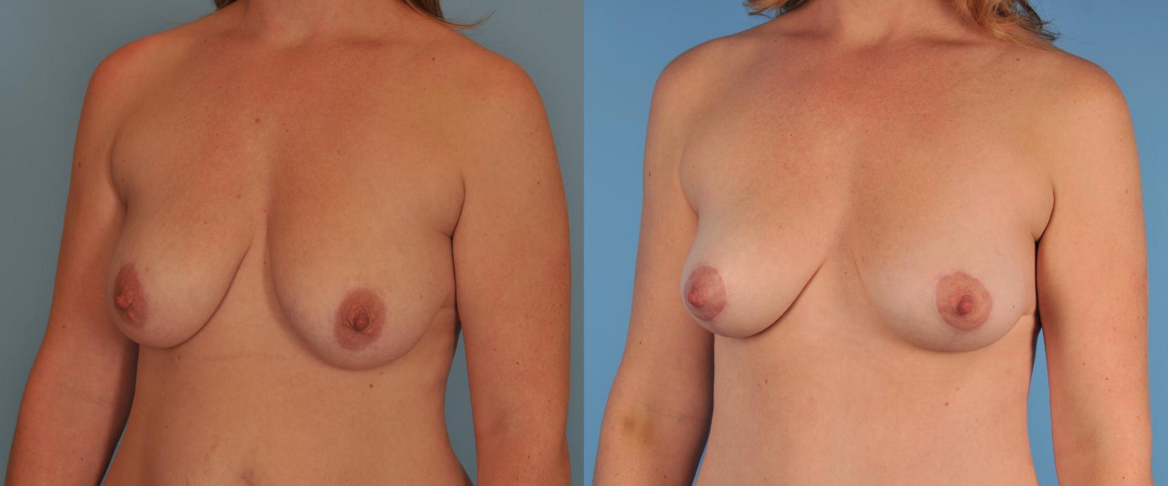 Before & After Breast Lift Case 62 View #1 View in Toronto, ON