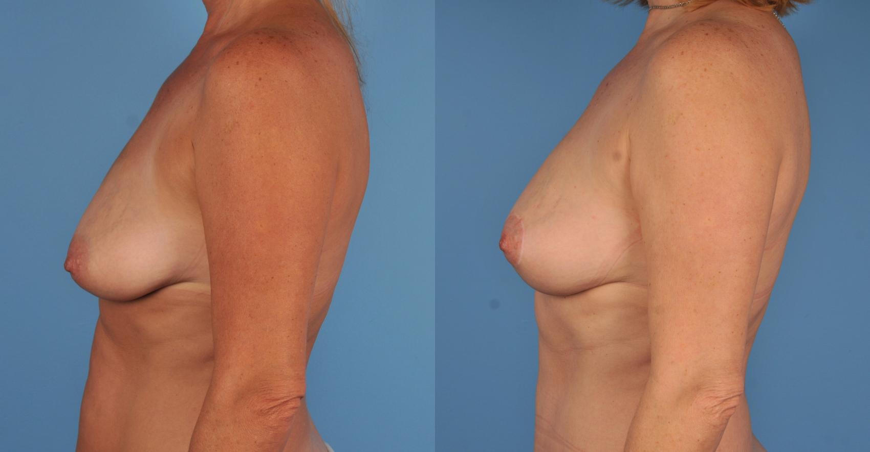 Before & After Breast Lift Case 66 View #1 View in Toronto, ON