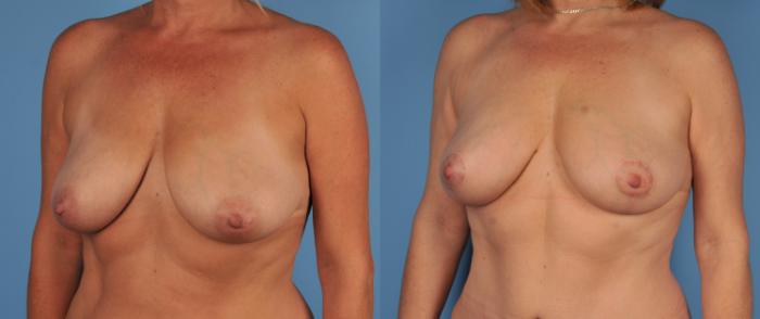 Before & After Breast Lift Case 66 View #2 View in Toronto, ON