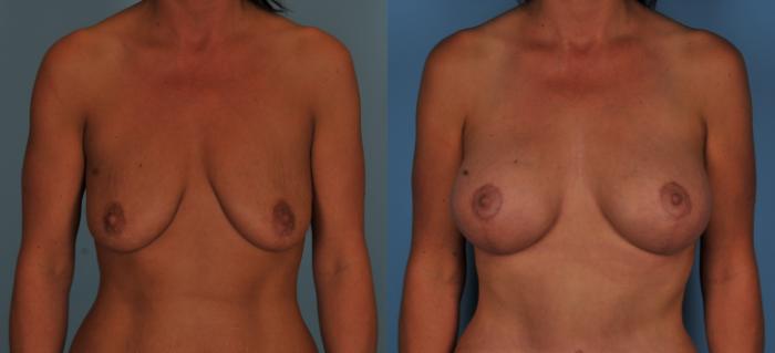 Before & After Breast Lift Case 71 View #1 View in Toronto, ON