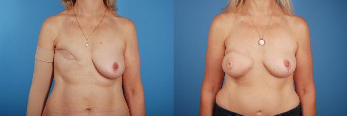 Before & After Breast Reconstruction Case 67 View #1 View in Toronto, ON