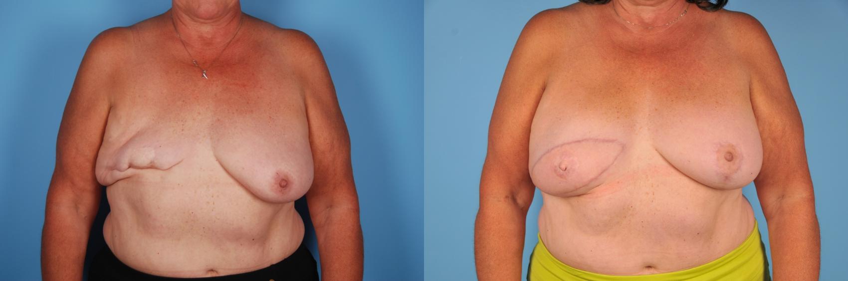 Before & After Breast Reconstruction Case 68 View #1 View in Toronto, ON