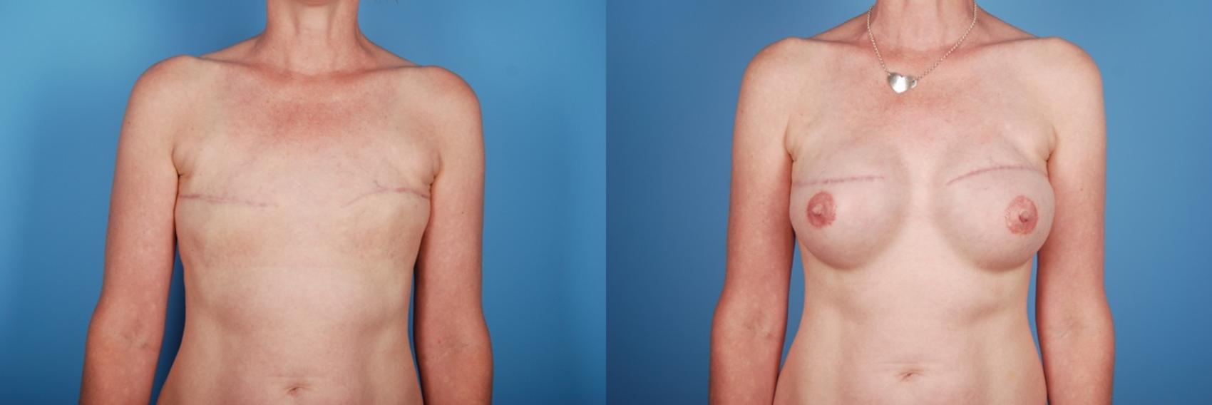 Before & After Breast Reconstruction Case 69 View #1 View in Toronto, ON