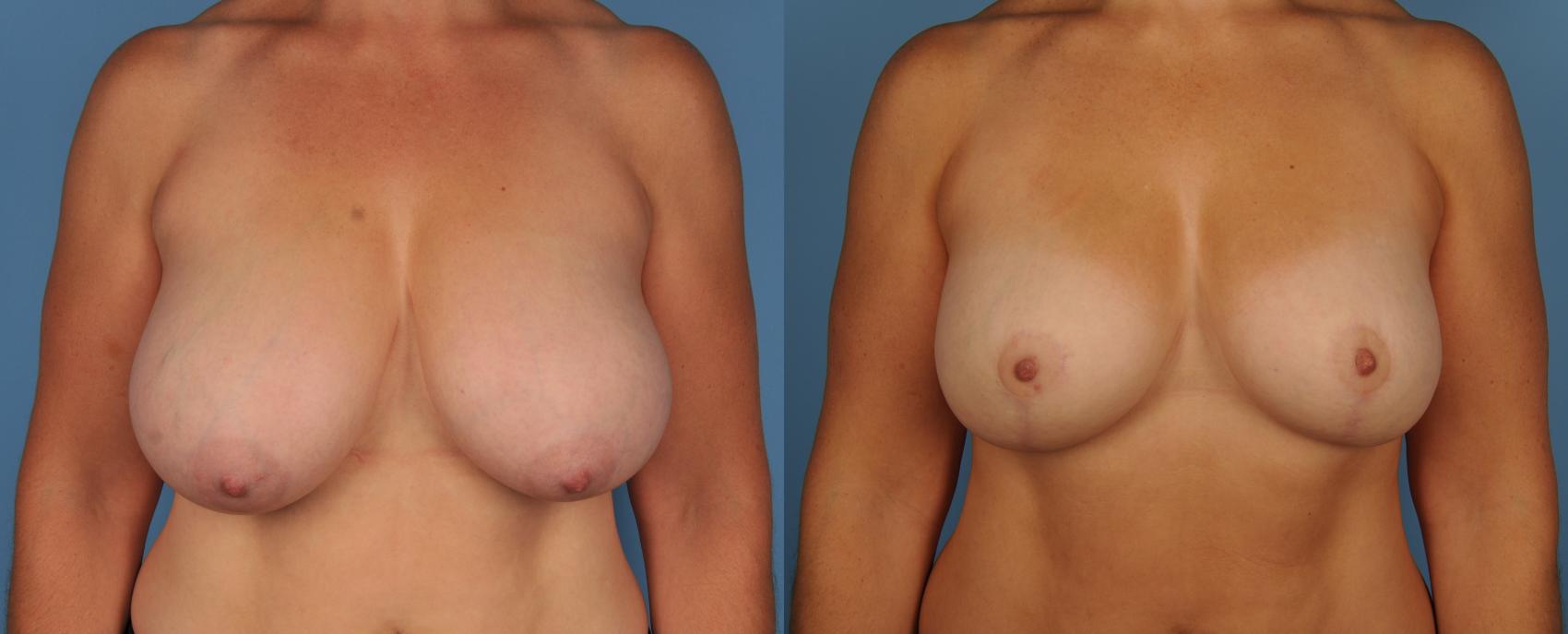 Before & After Breast Reduction Case 120 View #1 View in Toronto, ON