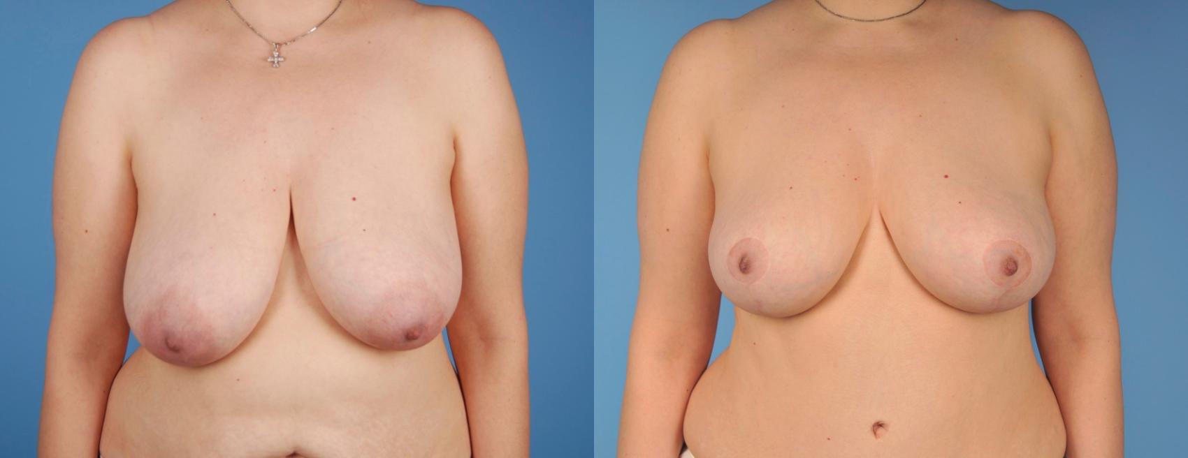 Before & After Breast Reduction Case 21 View #1 View in Toronto, ON
