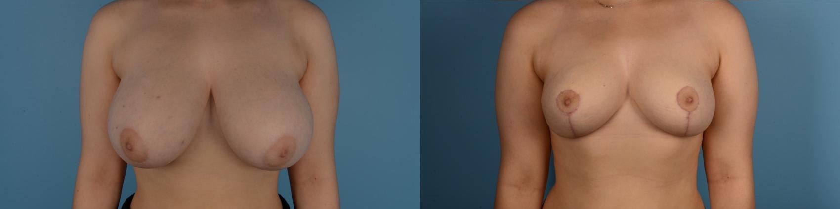 Before & After Breast Reduction Case 303 Front View in Toronto, ON