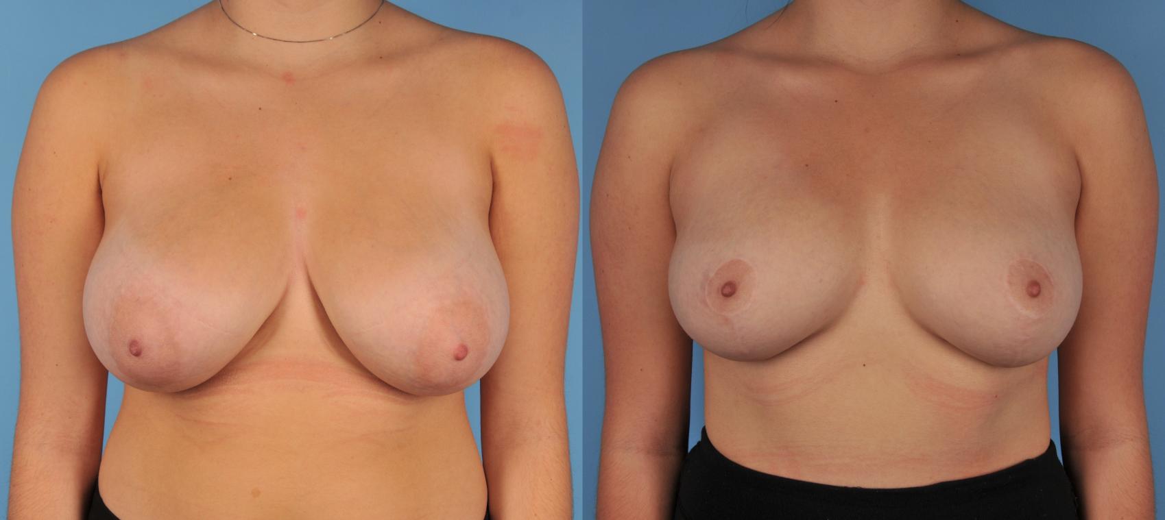 Before & After Breast Reduction Case 61 View #1 View in Toronto, ON