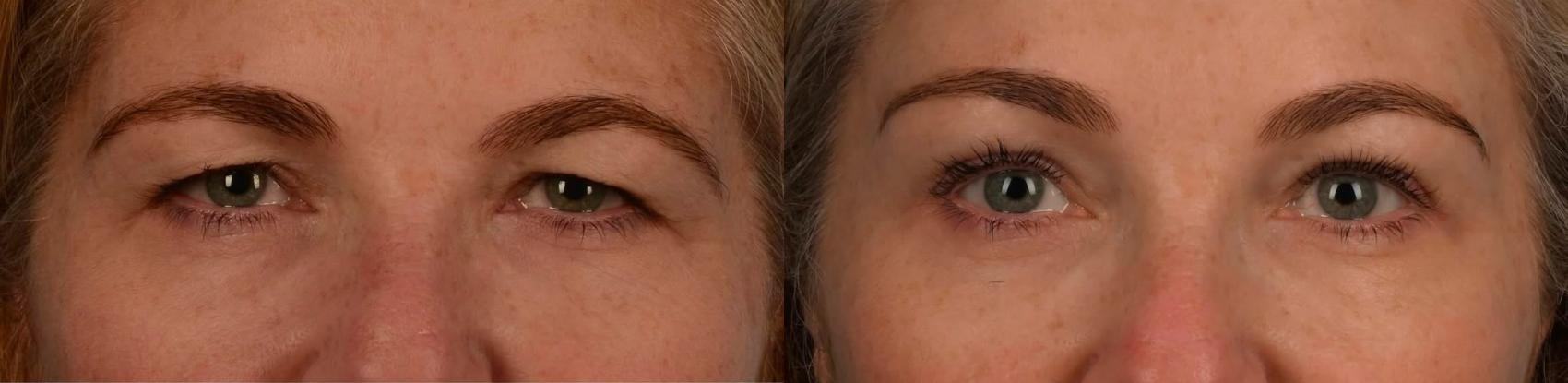 Before & After Brow Lift Case 309 Front View in Toronto, ON