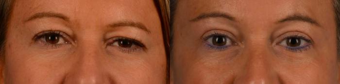 Before & After Brow Lift Case 310 Front View in Toronto, ON