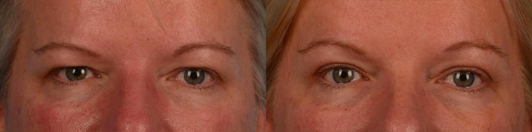 Before & After Brow Lift Case 312 Front View in Toronto, ON