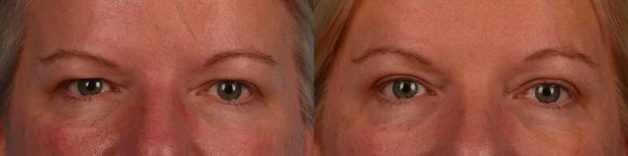 Before & After Brow Lift Case 312 Front View in Toronto, ON