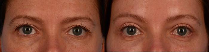 Before & After Brow Lift Case 313 Front View in Toronto, ON