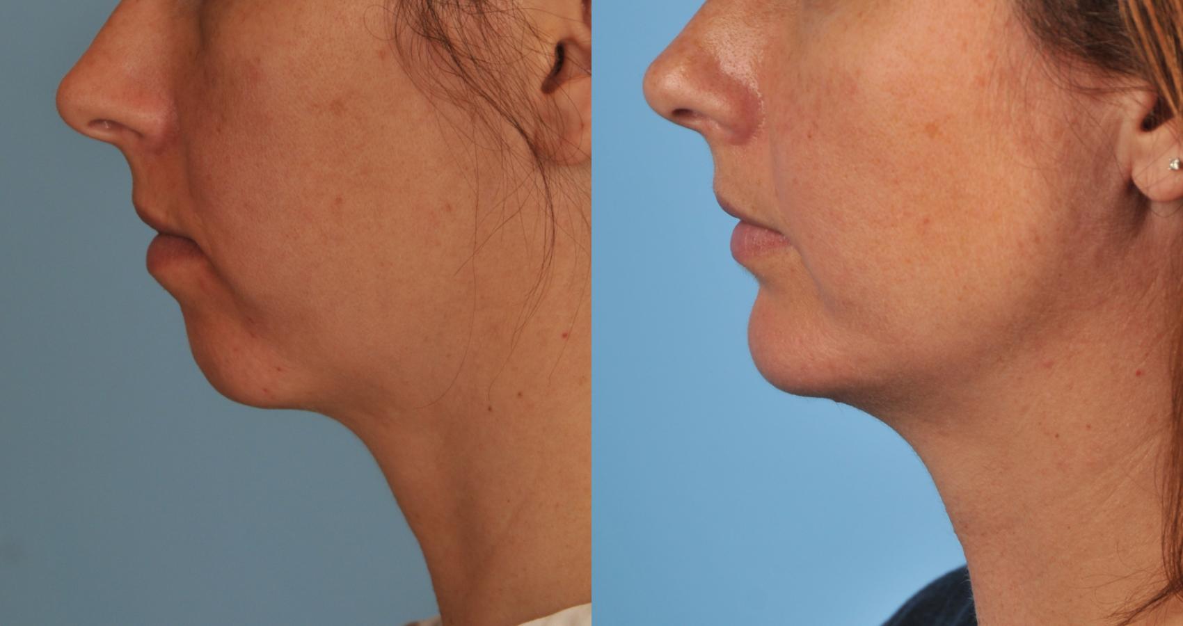 Before & After Chin Augmentation Case 137 View #1 View in Toronto, ON
